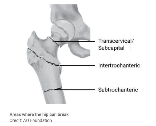 The hip can break in 3 ways. One: across the neck of the bone (called a transcervical or subcapital hip fracture). Two: below the neck of the bone (called an intertrochanteric hip fracture). Three: Across the shaft of the bone (called a subtrochanteric hip fracture)