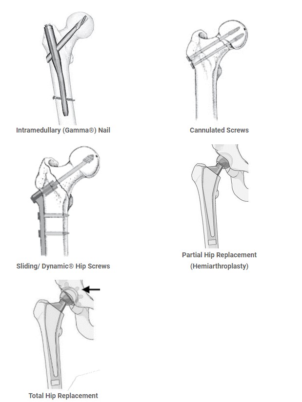 -Intramedullary (gamma) nail involves placing a nail/rod down into the femur and a screw up into the head of the femur. The nail/rod is secured with a screw lower down the femur. -Cannulated Screws involves placing screws across the neck of the femur into the head of the femur. -Sliding/dynamic hip screw involves placing a screw up the femoral neck to the head of the femur then linking it to a plate that runs alongside the femur and is held in place with 1-4 screws. -Partial hip replacement (hemiarthroplasty) involves removing the fractured head and neck of the femur and replacing the fractured bone with a prostheses (an artificial, metal implant) -Total Hip replacement involves replacing both the ball at the upper end of the femur (fractured femoral head or neck) and hip socket (acetabulum) in the pelvic bone.