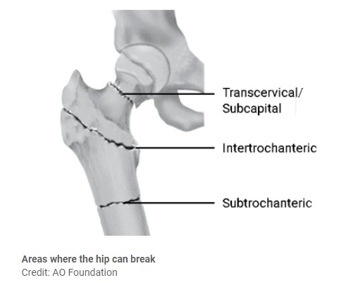 Surgery To Repair A Hip Fracture What To Expect At Home 4005