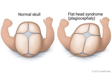 Side-by-side view of normal infant skull and infant skull with flattening on one side