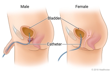 Catheter tube running from inside the bladder to outside the body in male and female bodies
