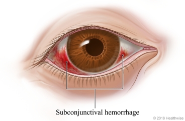Subconjunctival hemorrhage, with blood causing a large red area in white of eye