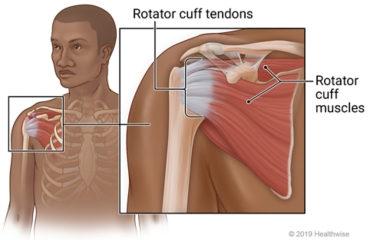Rotator cuff around top of arm bone at shoulder, with close-up of rotator cuff tendons and muscles.