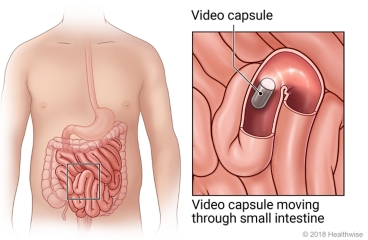 The small intestine, with detail of the video capsule moving through it