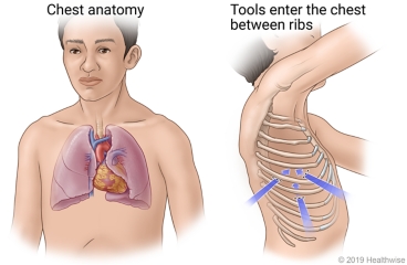 Chest anatomy, with side view of where surgical tools enter the chest between the ribs