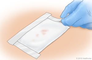 Taping the outer dressing on a well-packed wound