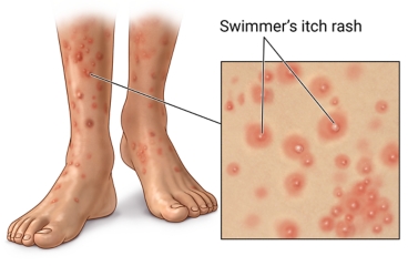 Raised red patches of swimmer's itch rash on lower legs, ankles, and feet