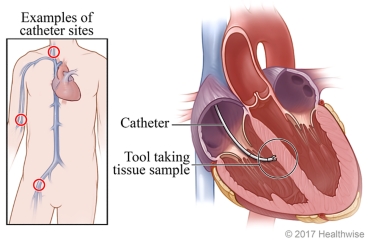 Catheter sites with cross section of heart showing tool taking tissue sample