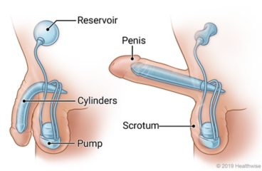 Inside view of inflatable penile implant, in both relaxed and erect positions, showing the penis, scrotum, reservoir, cylinders, and pump