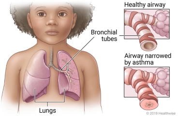 Location of the lungs and bronchial tubes, with detail of a healthy airway vs. an airway narrowed by asthma