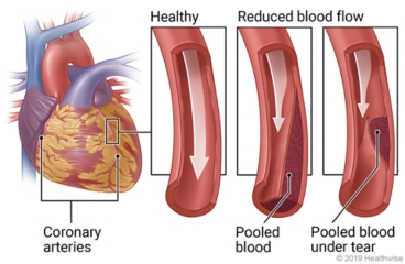 Location of coronary arteries on the heart, with detail views of healthy blood flow and reduced blood flow caused by pooled blood in the artery and pooled blood under a tear in the artery wall