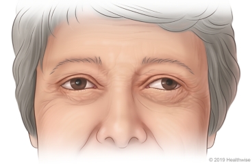 Person with strabismus, with one eye looking straight ahead and other eye looking to the side