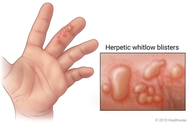 Herpetic whitlow on top section of child's finger, with closeup of redness and blisters on skin