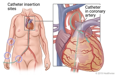 Catheter insertion sites on arm and groin, showing catheter from groin to heart, and detail of catheter in coronary artery