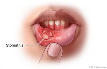 Inside of the lower lip, showing stomatitis sores
