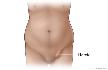Bulge of hernia in groin area