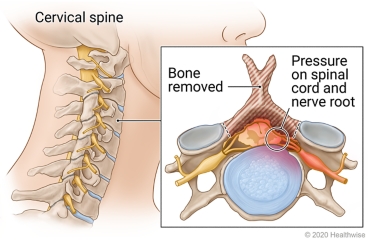 Cervical spine in neck, with detail showing cervical vertebra (bone to be removed) putting pressure on spinal cord and nerve root