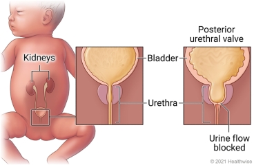 Healthy urethra and bladder compared to urethra with blocked urine flow to the bladder (posterior urethral valve).