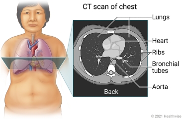 Location of area of chest scanned in CT scan, showing cross-section image of lungs, heart, ribs, bronchial tubes, and aorta.