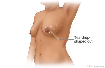 Breast showing incision site for skin-sparing mastectomy with teardrop cut around the areola.