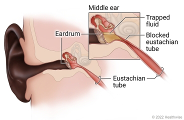 Ear, eardrum, and middle ear, with detail of trapped fluid in middle ear and blocked eustachian tube.