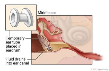 Temporary ear tube placed in eardrum, showing fluid from middle ear draining into ear canal.