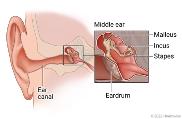Inside view of ear, showing ear canal and middle ear with detail of ear drum and bones of middle ear (malleus, incus, and stapes).