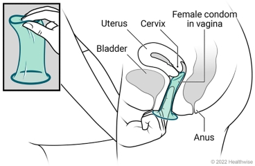 Female pelvic organs, showing a uterus, cervix, bladder, and anus, with detail of internal (female) condom and placement in vagina.