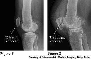 Images of a normal and broken kneecaps