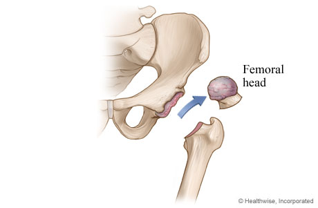 Hip replacement: Damaged cartilage and bone are removed.