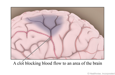 Brain, showing blood clot blocking blood flow to area of brain
