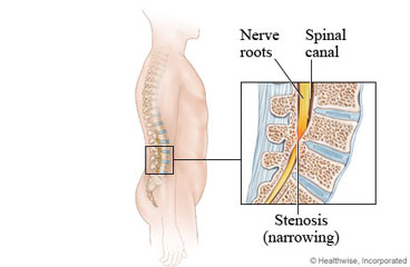 Spinal canal and nerve roots with stenosis