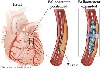Stent placed in a coronary artery