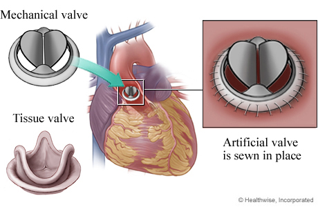 Mechanical valve and tissue valve, showing mechanical valve in heart, with detail of valve sewn in place.