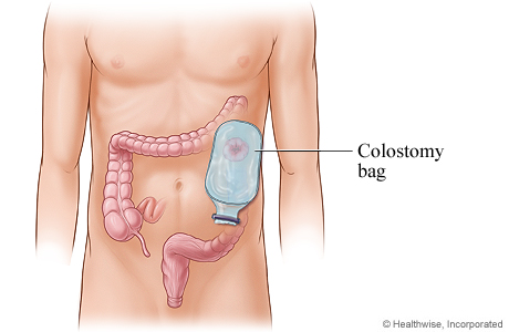 A colostomy bag positioned on the stoma