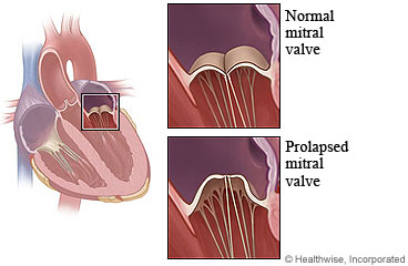 Normal and prolapsed mitral valves