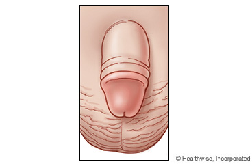 Child's circumcised penis