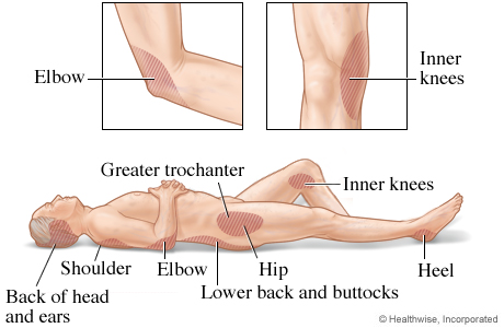 Areas where pressure injuries commonly develop.