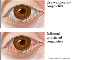 Healthy eye and an eye with conjunctivitis