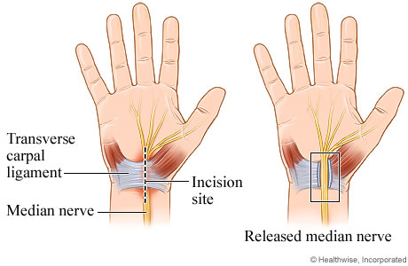 Open carpal tunnel release surgery.