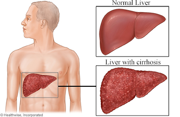 Normal liver and a liver with cirrhosis.