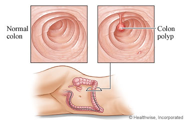 Normal colon and colon polyp