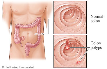 Picture of a normal colon and colon polyps
