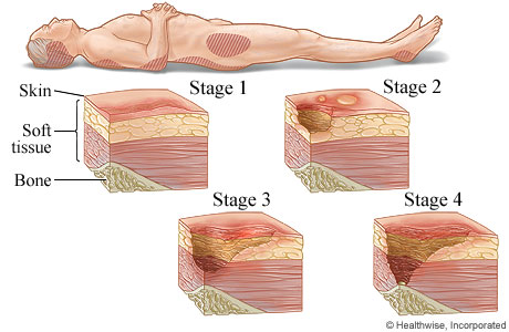The four stages of pressure injuries.