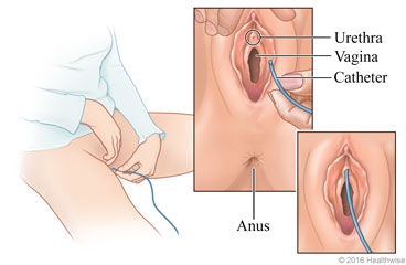 Woman inserting catheter, with detail of urethra, vagina, and catheter insertion