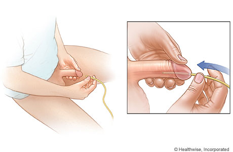 Man inserting catheter into urethra opening at end of penis.