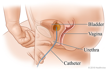 Side view of female anatomy, showing the insertion of the catheter