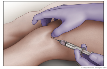 Position of needle for injection into knee joint