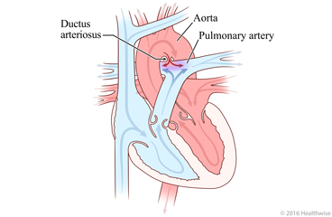 Heart showing patent ductus arteriosus and change in blood flow