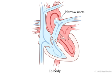 Heart with narrowed aorta